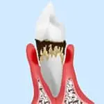 後期の歯周病治療