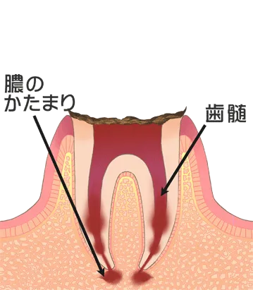 C4（歯の根まで進行した虫歯）