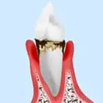 中期の歯周病治療