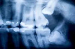 口腔内のレントゲン写真